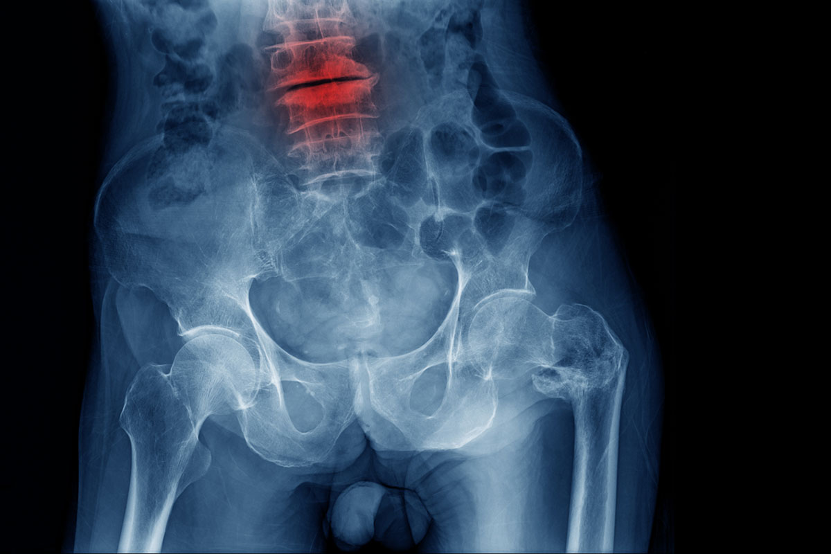 x-ray of spinal fractures