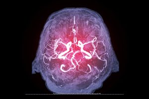 MRI of cerebrovascular system of the brain