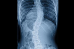 MRI of a patient with scoliosis