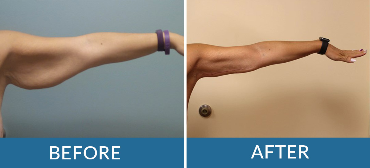 a woman's arm after brachioplasty arm lift surgery with brain and spine surgeons of new york