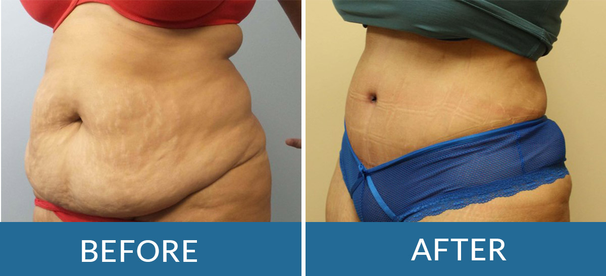 Before and after photos of a woman following abdominoplasty surgery with brain and spine surgeons of new york