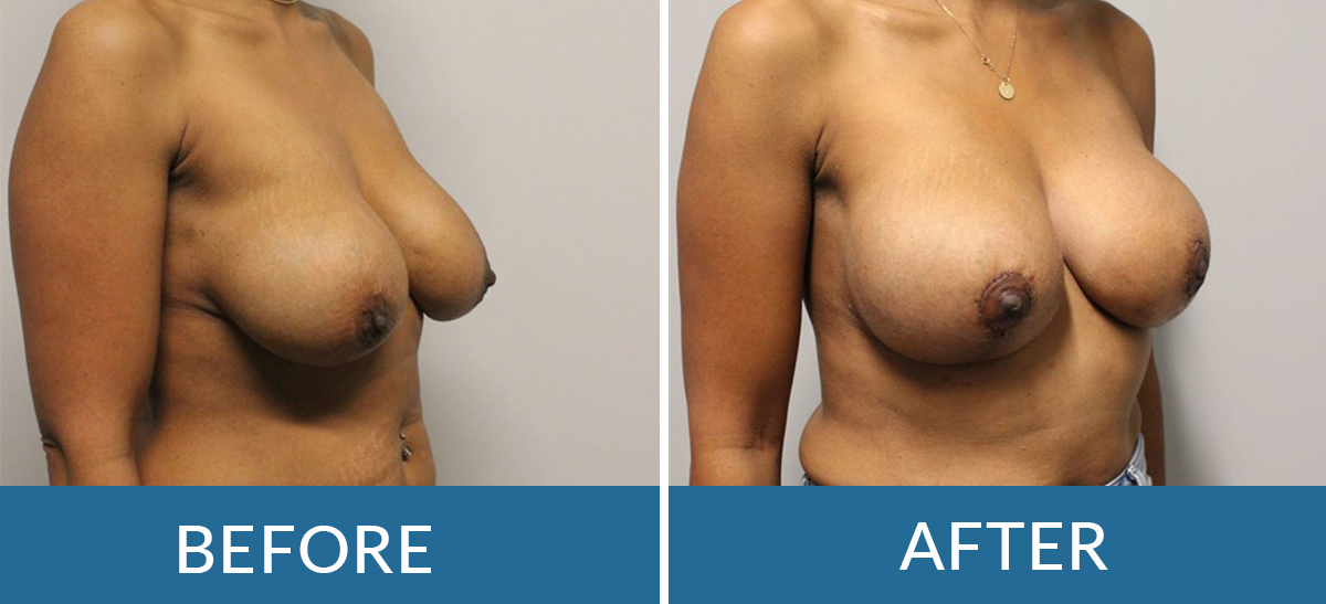 before and after photos of a woman having breast lift surgery with brain and spine surgeons of new york