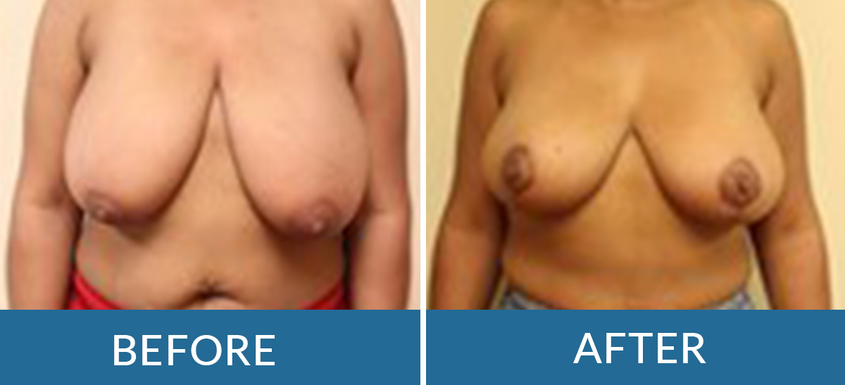 before and after photos of a woman having breast lift surgery with brain and spine surgeons of new york