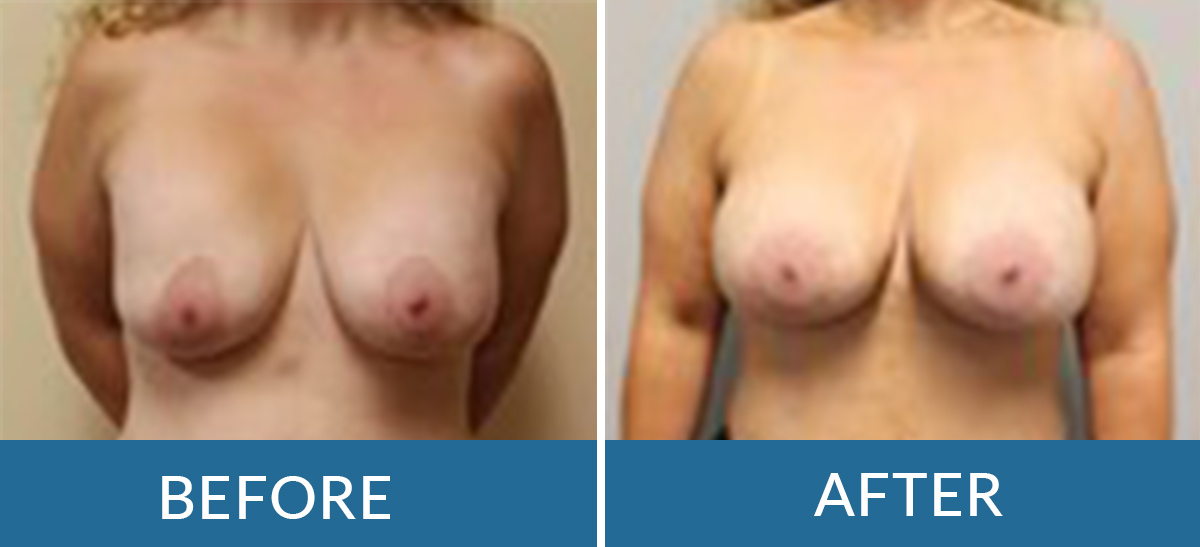 before and after photos of a woman having breast lift surgery with brain and spine surgeons of new york