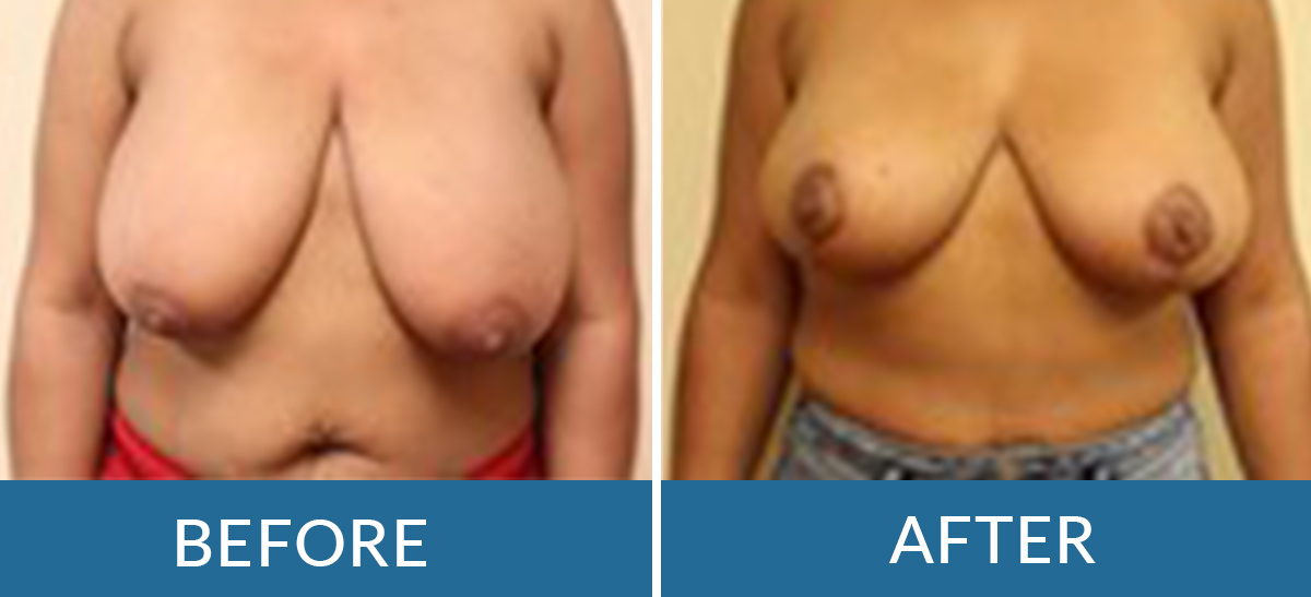 before and after photo of a woman having breast reduction surgery