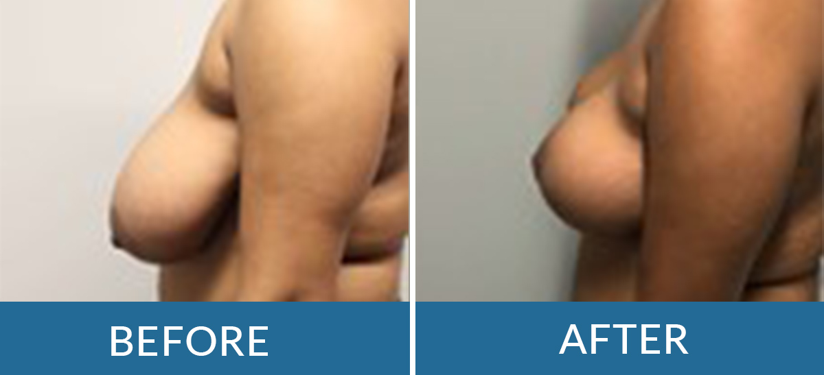 before and after photo of a woman having breast reduction surgery