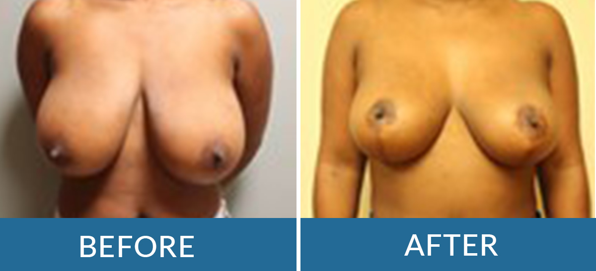 before and after photo of a woman having breast reduction surgery