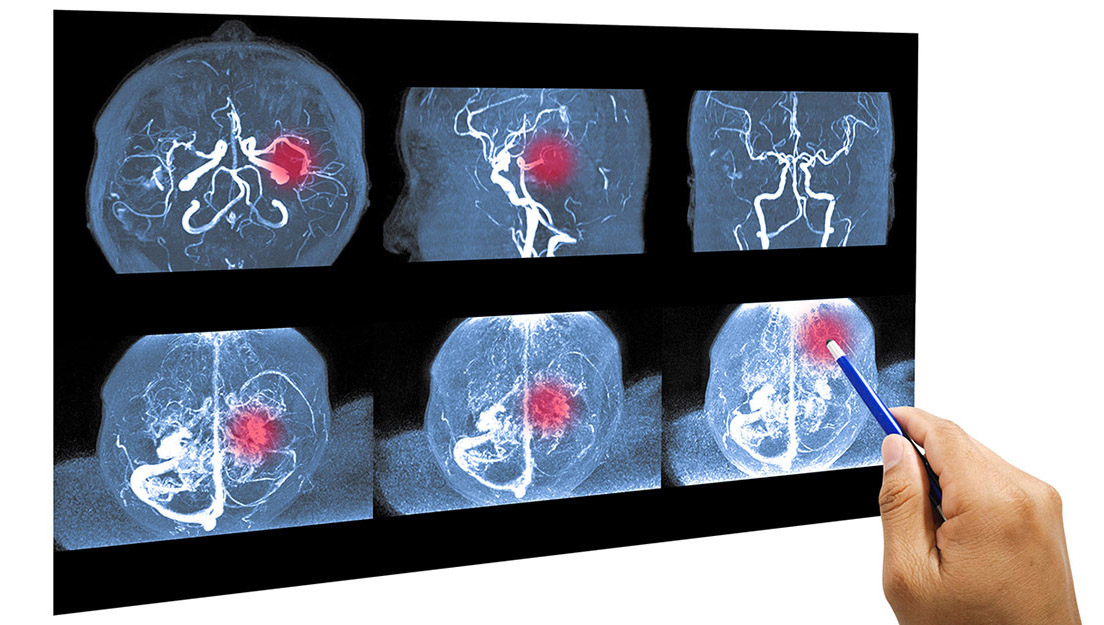 MRI of a brain aneurysm