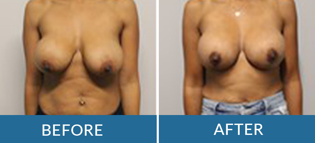 before and after photos of fat transfer surgery with BSSNY plastic surgeons