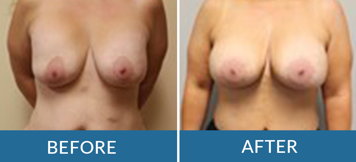 before and after photos of fat transfer surgery with BSSNY plastic surgeons