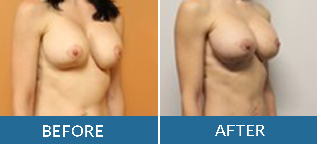 before and after photos of fat transfer surgery with BSSNY plastic surgeons