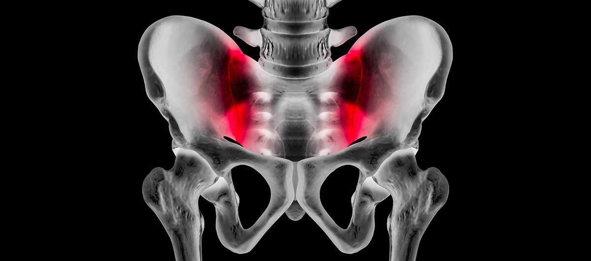 x-ray of someone with sacroiliitis