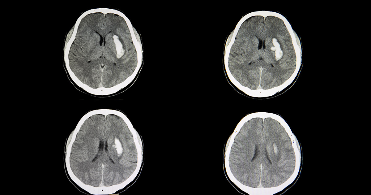 CT scan of an intracranial hemorrhage