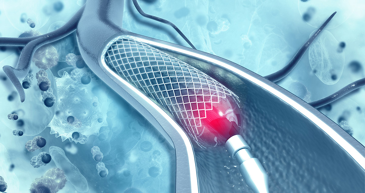 cranial stent placement