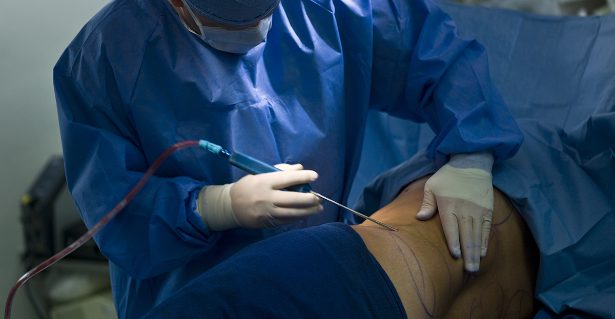 BSSNY plastic surgeon performing liposuction