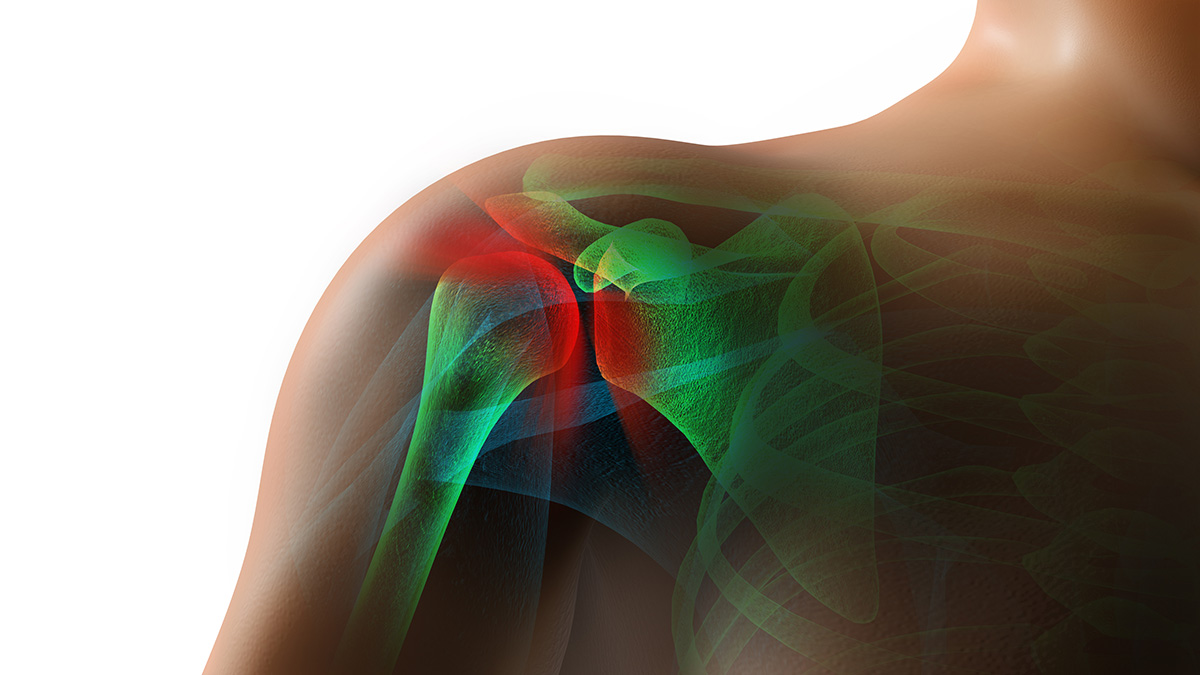 rotator cuff injury