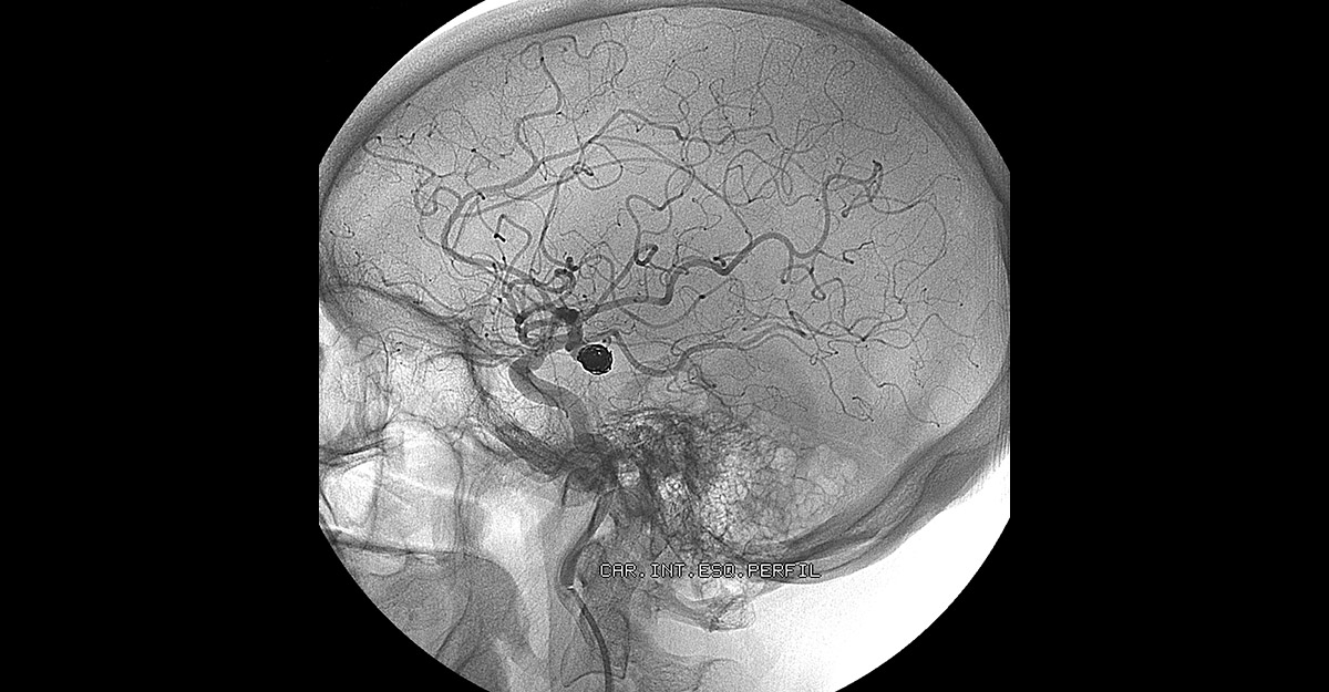 X-ray of an Endovascular Embolization