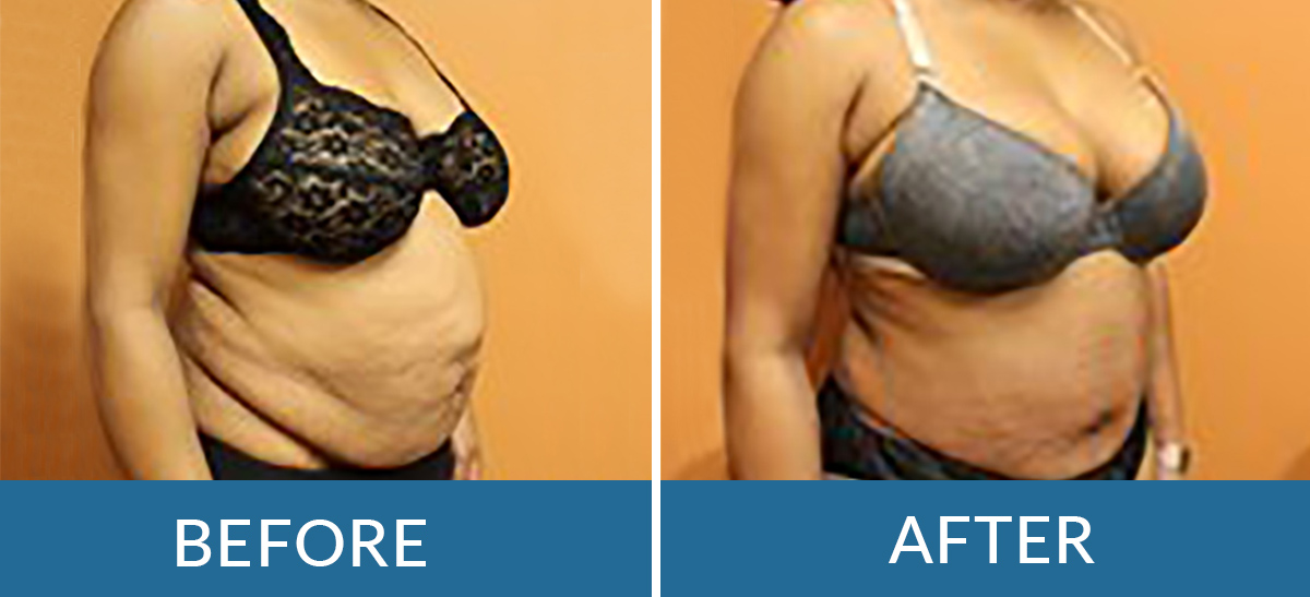 before and after photos of woman who had liposuction with plastic surgeons of BSSNY