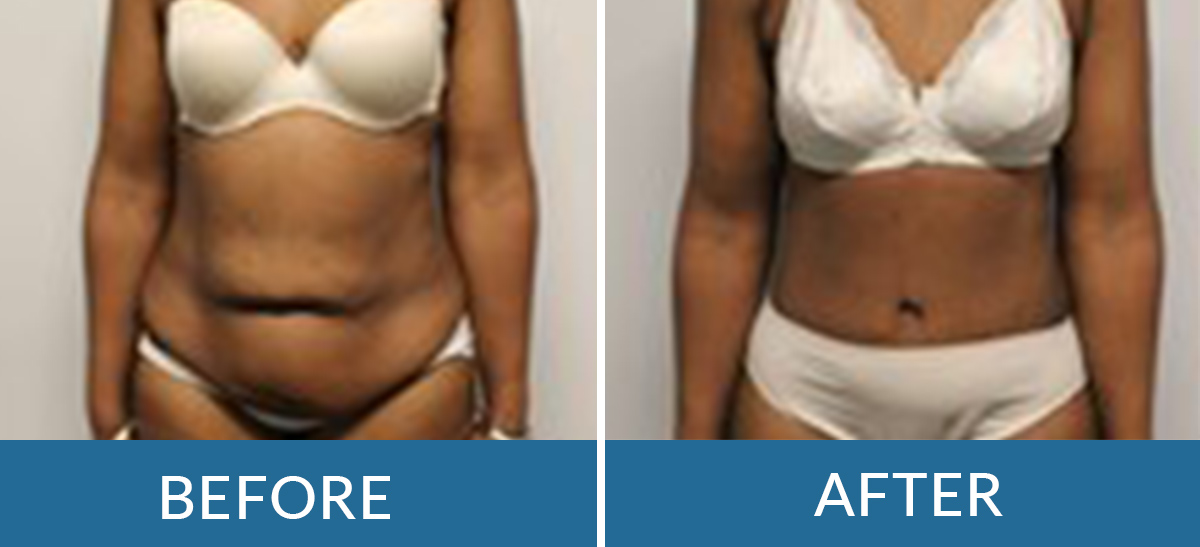 before and after photos of woman who had liposuction with plastic surgeons of BSSNY