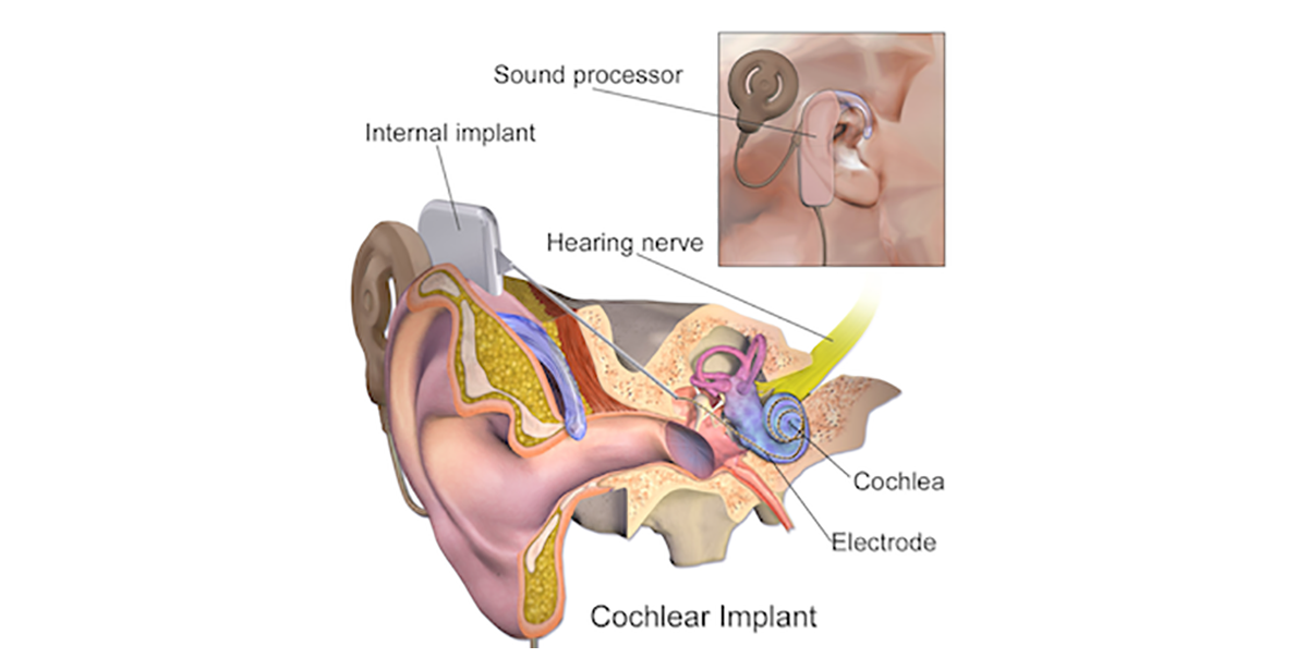 medical illustration depicting cochlear implant surgery