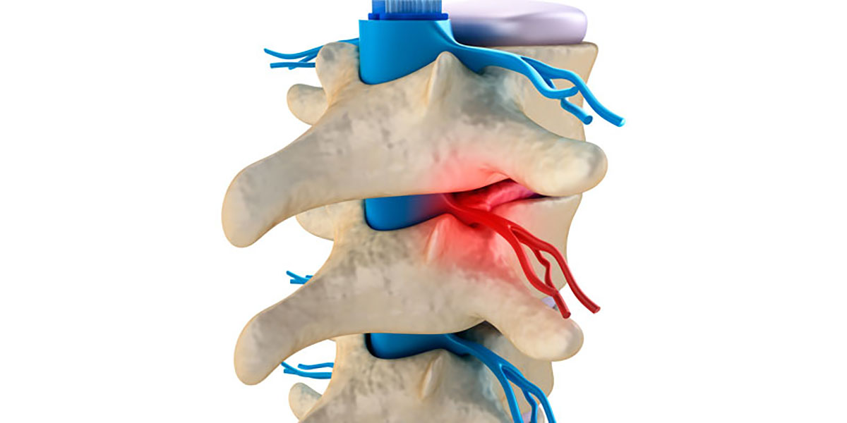 ablative procedures for neuropathic pain