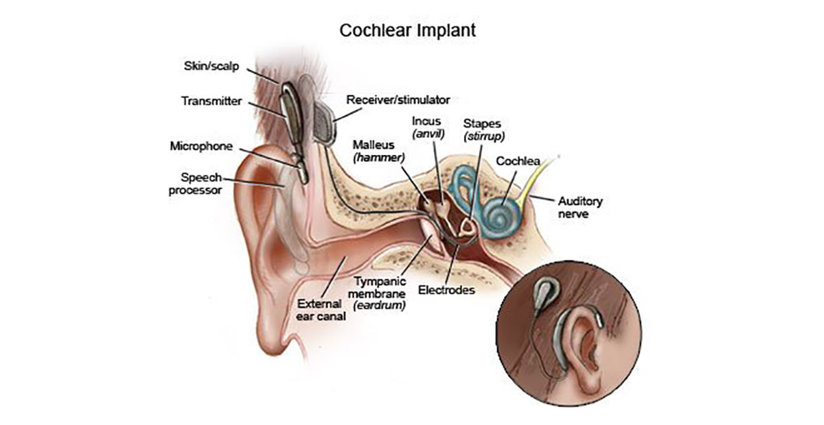 Medical illustration depicting cochlear implants for children