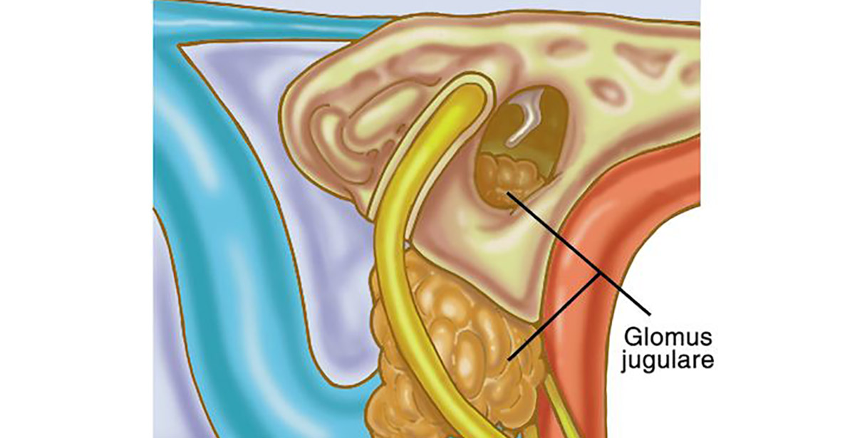 glomus tumor illustration