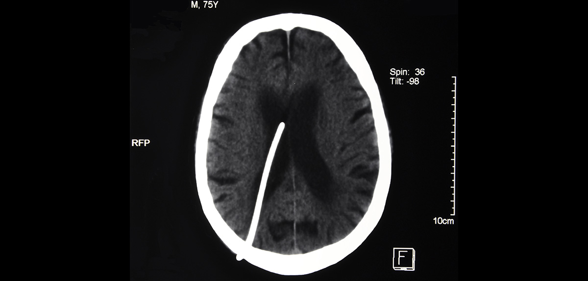 shunt placement for hydrocephalus