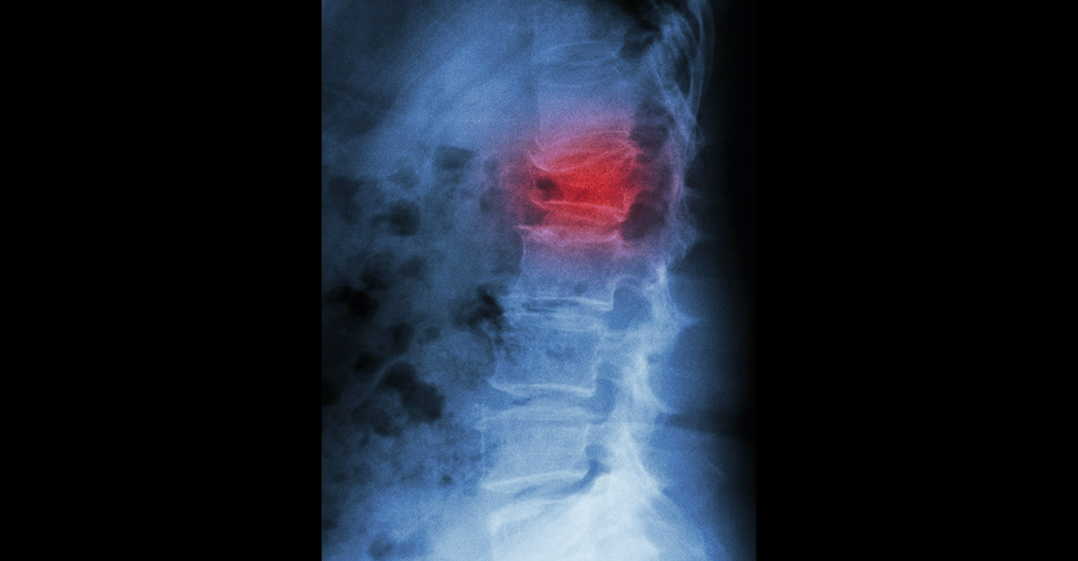 MRI of a vertebral compression fracture