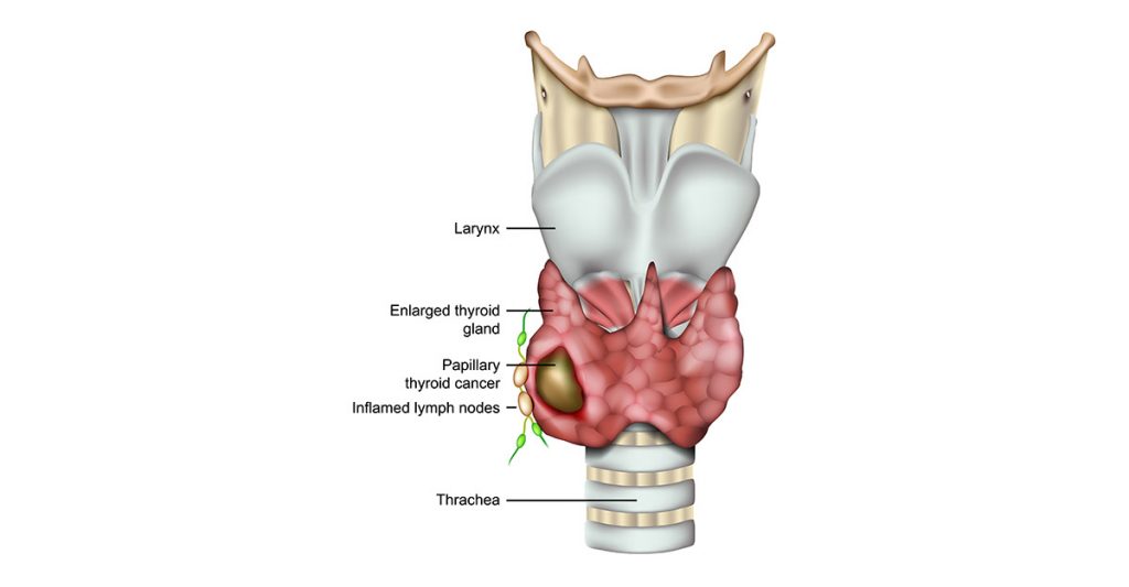 Lymph Node Removal - Brain & Spine Surgeons of New York