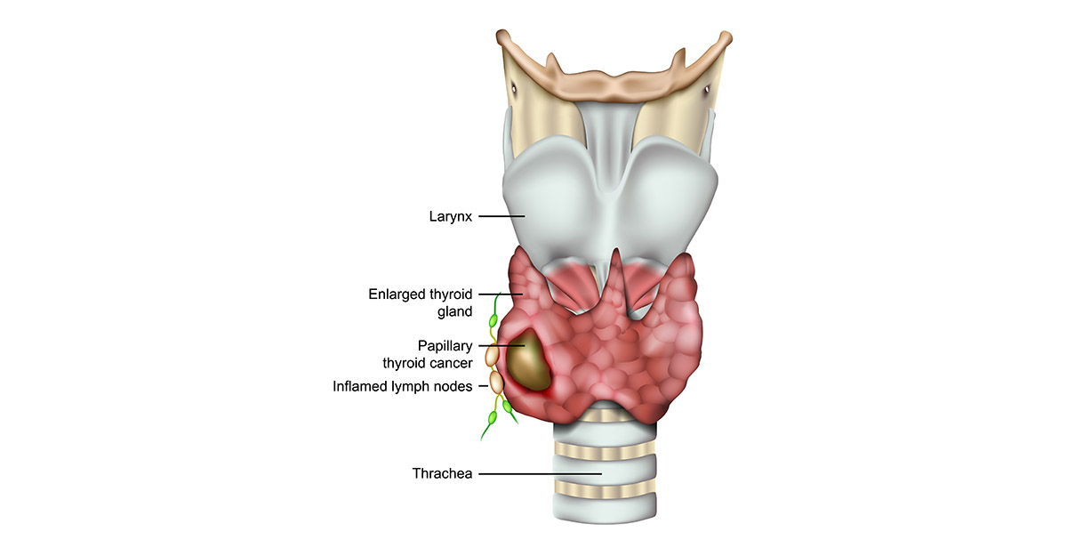 lymph node removal anatomy