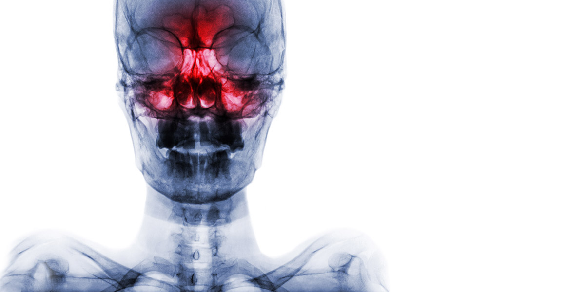 x-ray of nose and sinus tumors