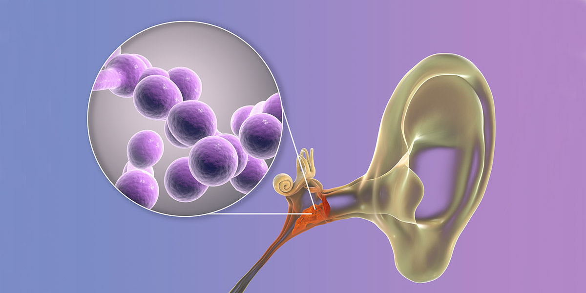 3D medical illustration of oiititus media