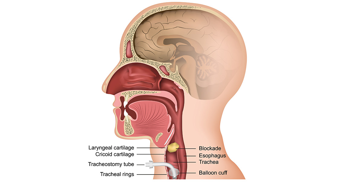 medical illustration of tracheostomy/tracheostomy surgery