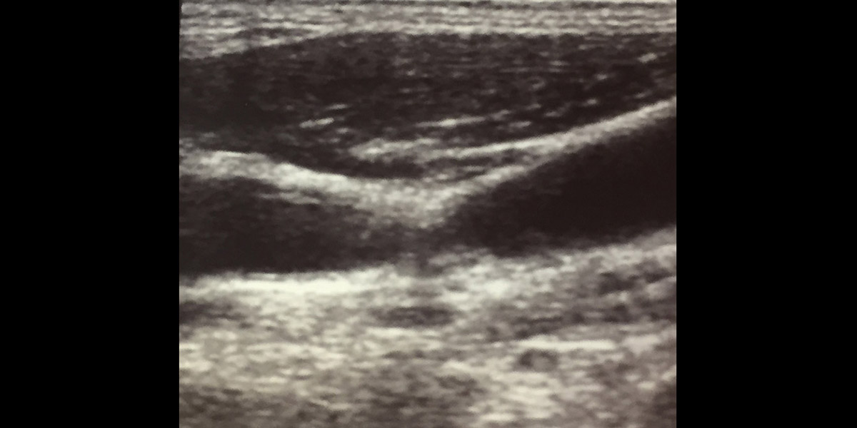 Sonogram of plaques causing stenosis of the carotid artery.