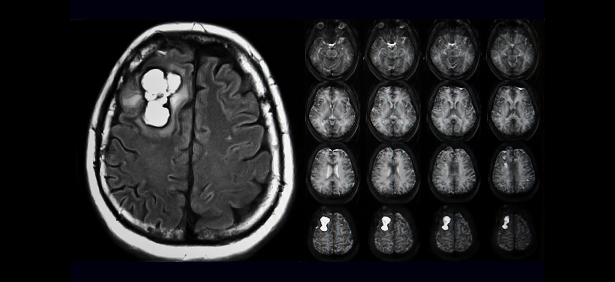 MRI of Glioblastomas