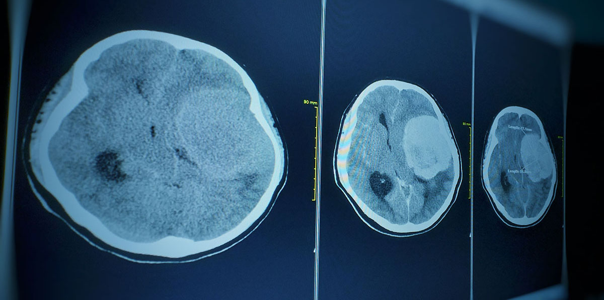 CT brain scan of Meningiomas