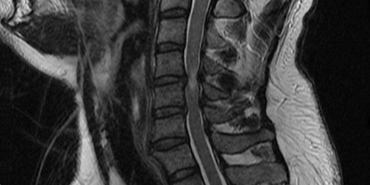 x-ray of Cervical Vertebrectomy