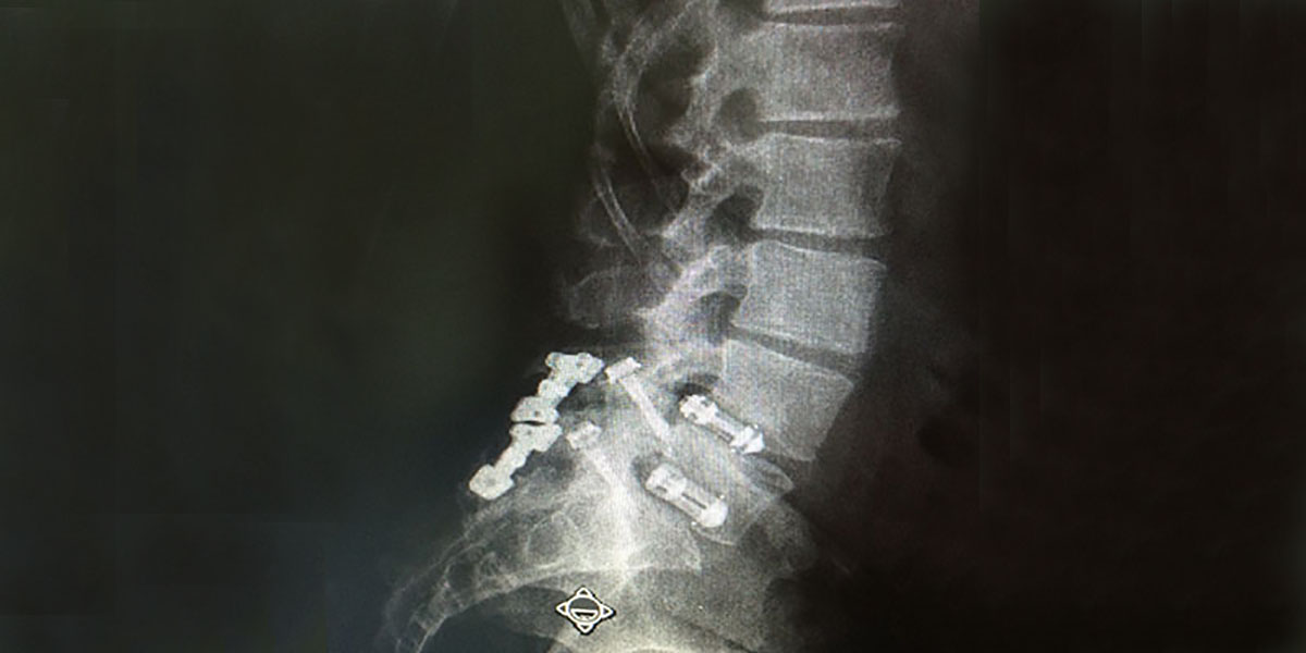 x-ray showing a patient with fractured spinal hardware