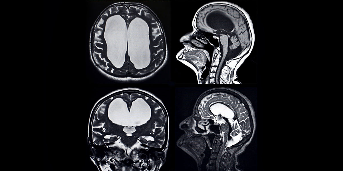 x-ray of a child with hydrosephalus