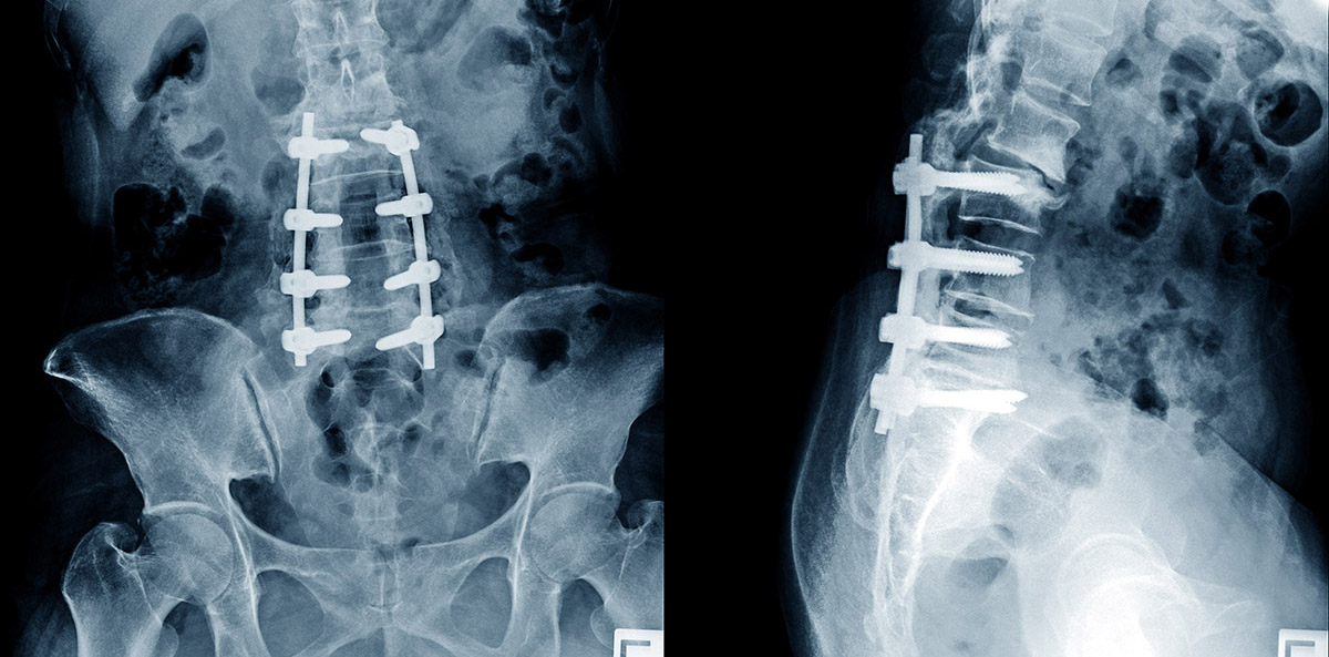 x-ray of patient with Lumbar Spinal Fusion