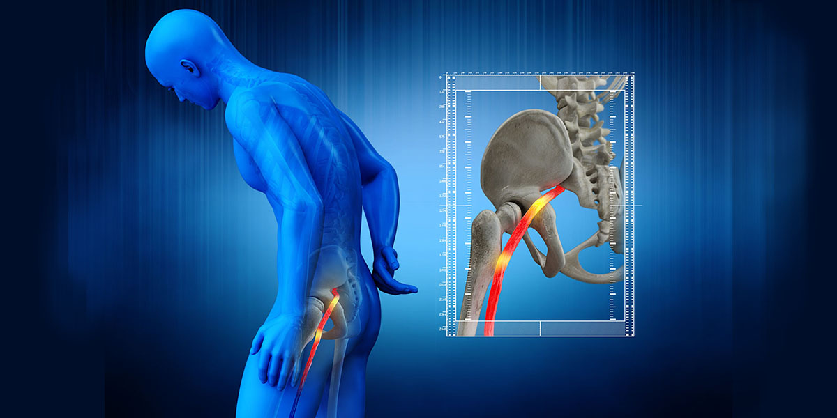 3d medical illustration of a man with sciatica