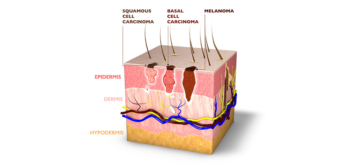 three types of skin cancer