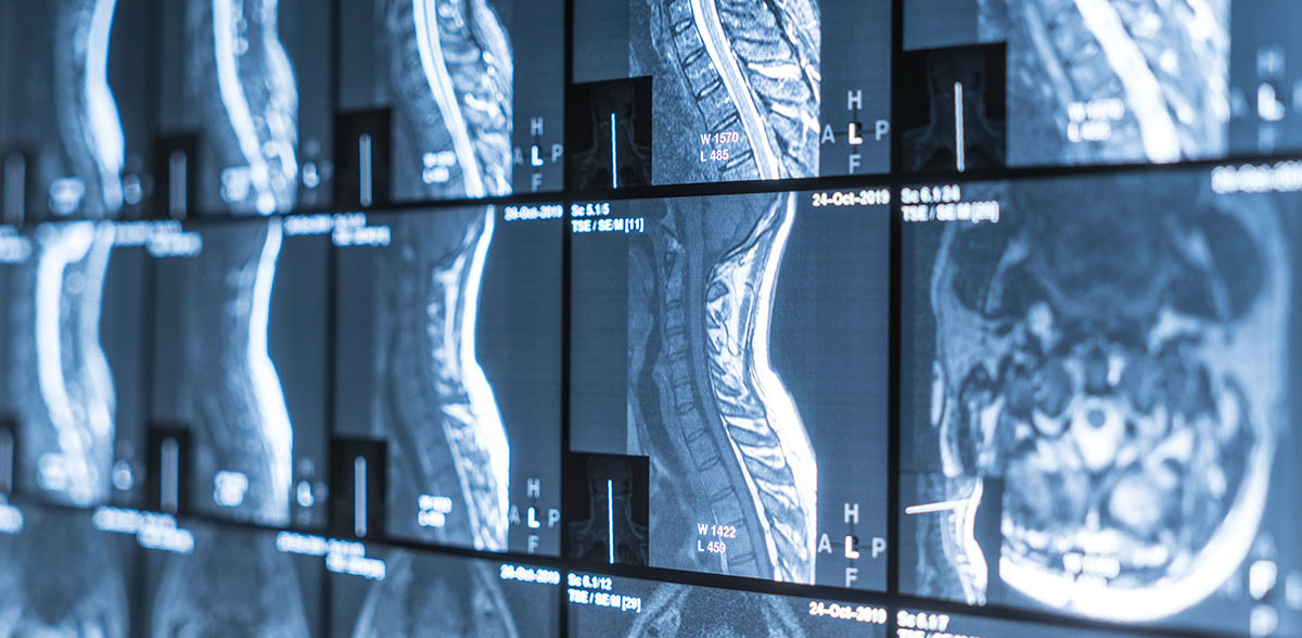 x-ray of a patient with Spinal Tumors