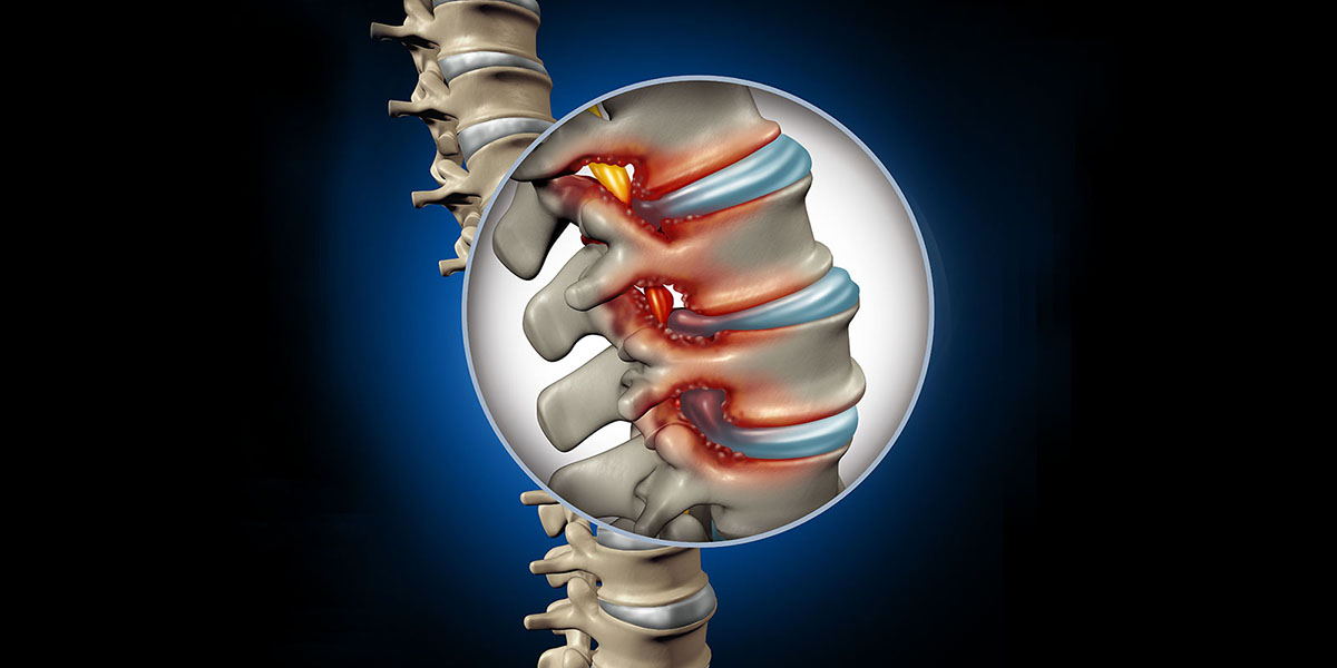 3d illustration of spinal stenosis