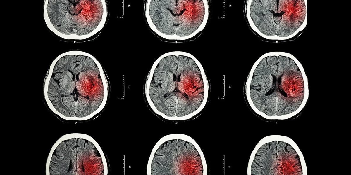 MRI of stroke brain with hemorrhaging