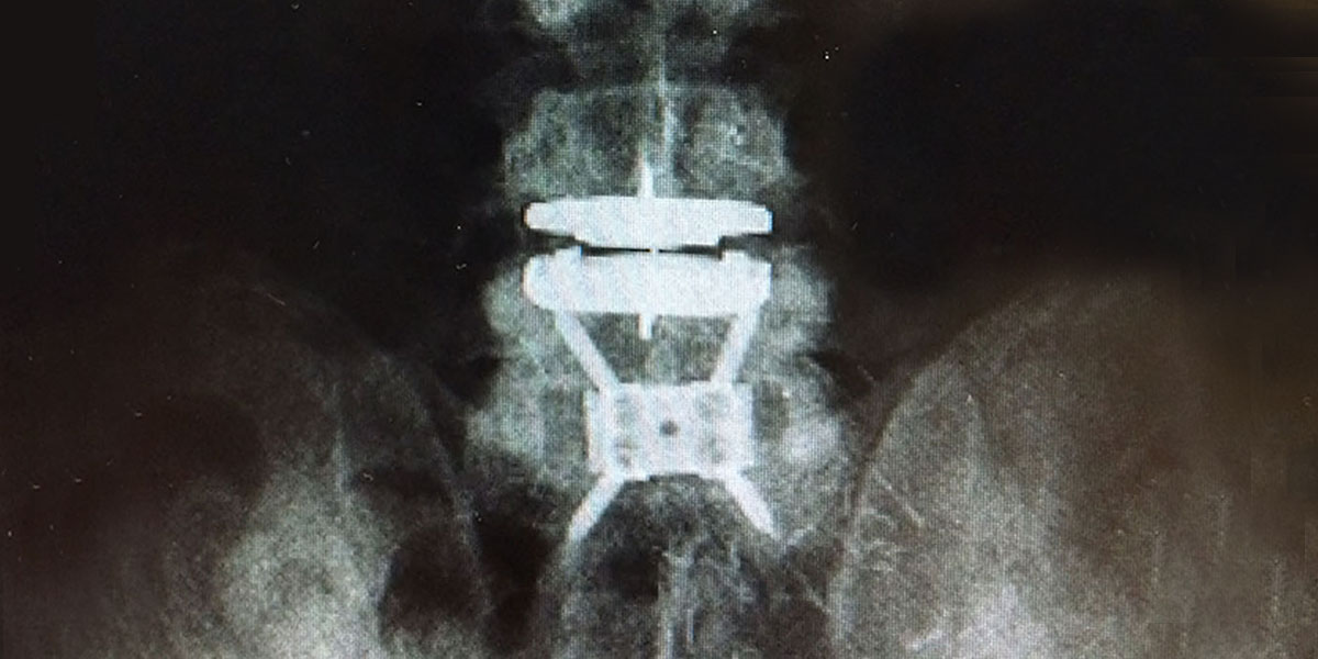 x-ray of a patient with a Total Disc Replacement